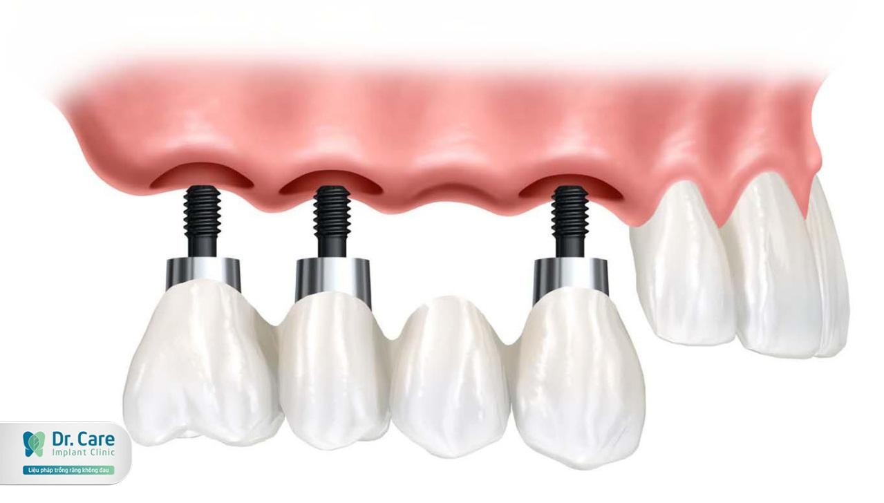 3. Phương pháp trồng răng Implant thay thế một vài răng tại Dr. Care - Implant Clinic 