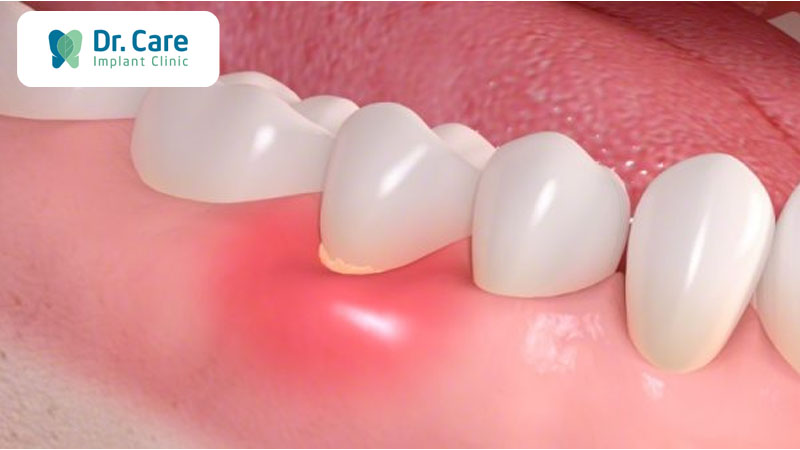 4 Hậu quả nghiêm trọng của áp xe răng