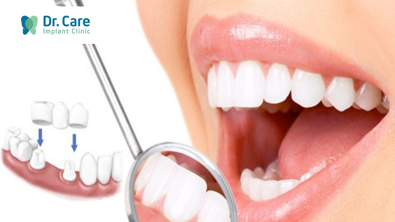 Bọc răng sứ thẩm mỹ là gì?