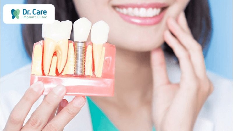 Trồng răng Implant phục hồi răng bị mất do bọc sứ thẩm mỹ