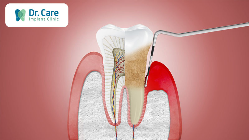 3 Nguyên nhân gây tụt lợi khi bọc răng sứ
