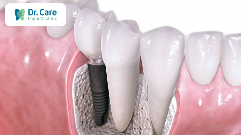 Điều trị mất răng vĩnh viễn do tụt lợi bằng cấy ghép Implant