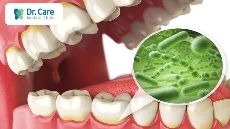 Tụt lợi gây nên bệnh lý răng miệng
