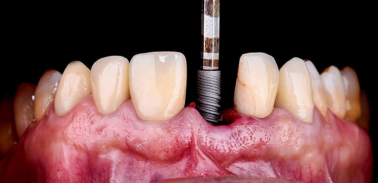 Biến chứng chảy máu liên tục sau khi trồng răng Implant là gì?