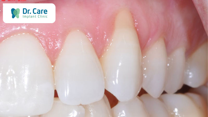 Hở chân răng là gì? Dấu hiệu nhận biết hở chân răng 