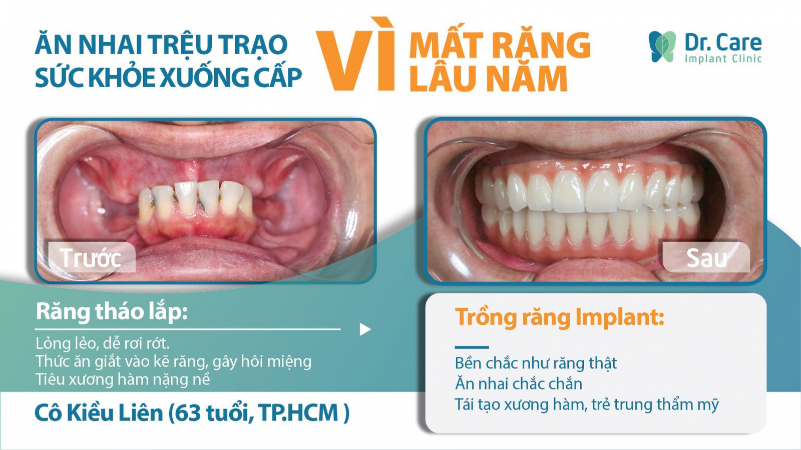 Ngăn chặn tiêu xương hàm, khắc phục lệch mặt do mất răng