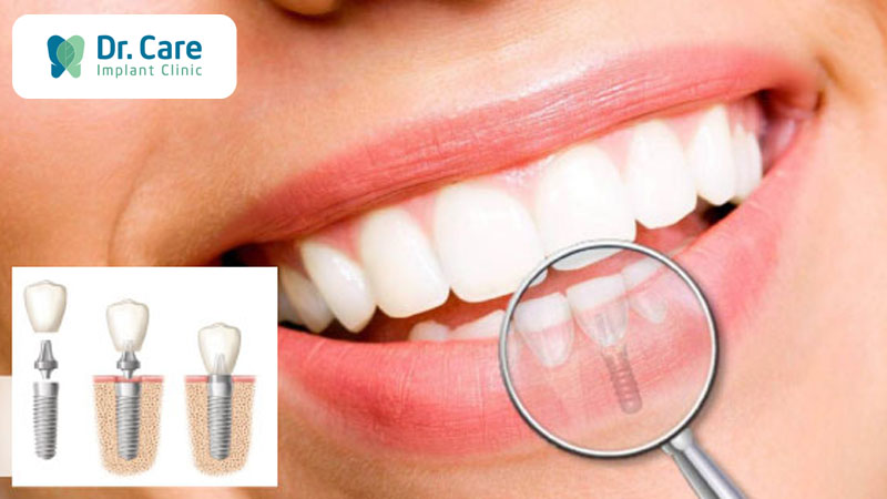 Bí quyết chăm sóc răng Implant đúng cách sau khi cấy ghép