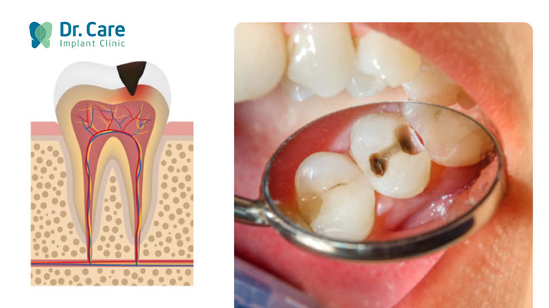 Các dấu hiệu và triệu chứng của sâu răng do lười đánh răng