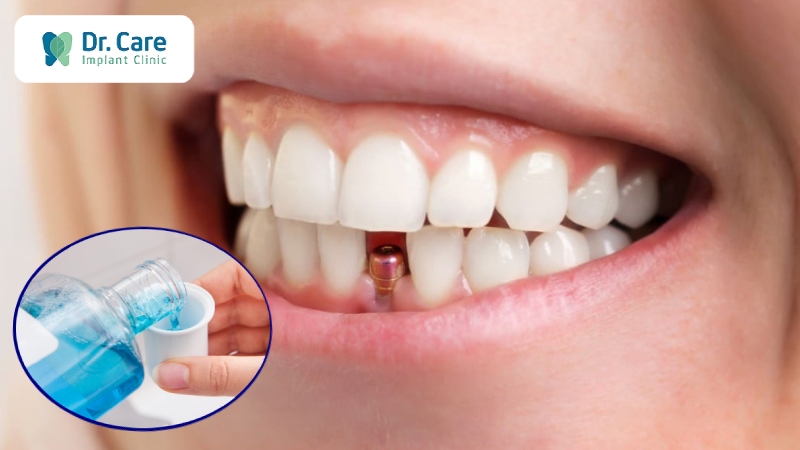 Sau khi trồng răng Implant có sử dụng nước súc miệng được không?