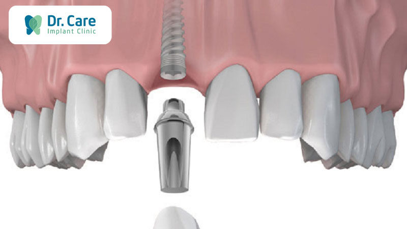 Bước 5: Gắn Abutment và răng sứ trên Implant