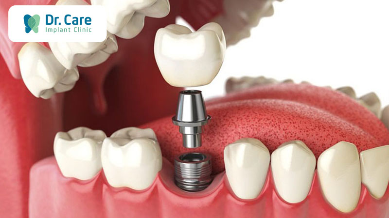 Trồng răng Implant khắc phục tình trạng sưng nướu do sử dụng hàm tháo lắp