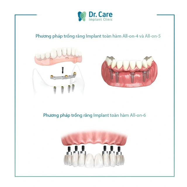 Trồng răng Implant trả góp là gì?