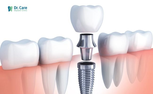 Trồng răng Implant