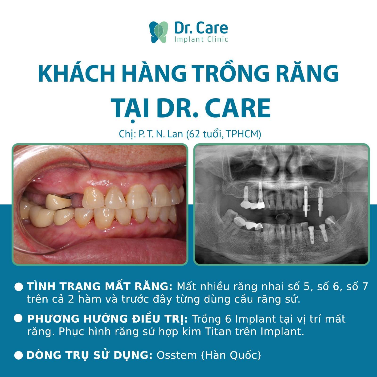 Phản hồi của Khách hàng đã trồng răng Implant tại Dr. Care - Implant Clinic
