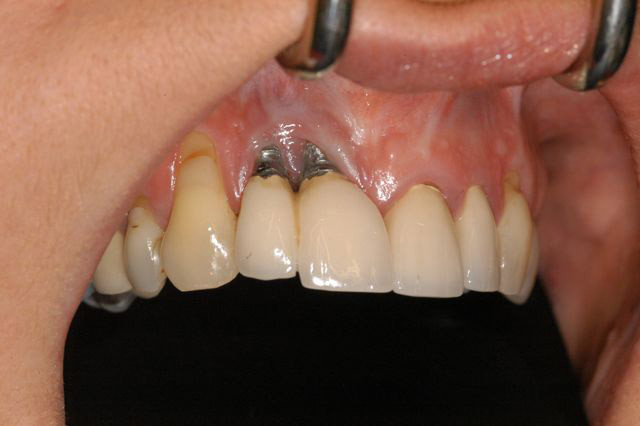 Vùng răng Implant bị nhiễm trùng