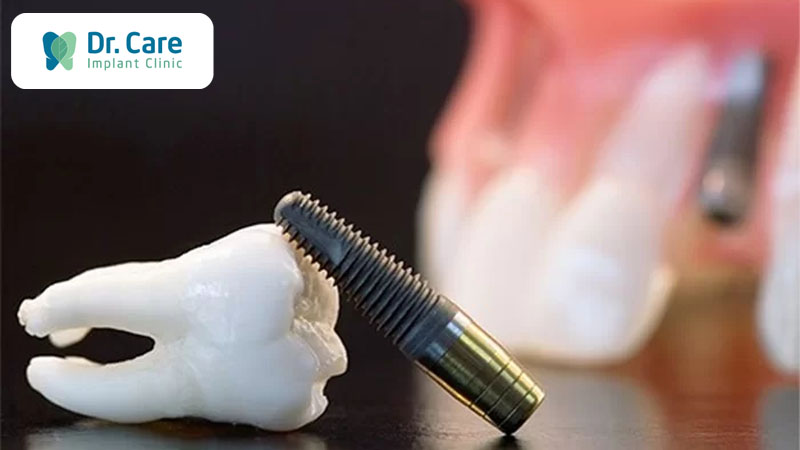 Có nên trồng răng Implant sau khi nhổ răng khôn không?