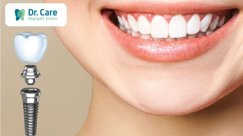 Răng Implant có tính thẩm mỹ cao