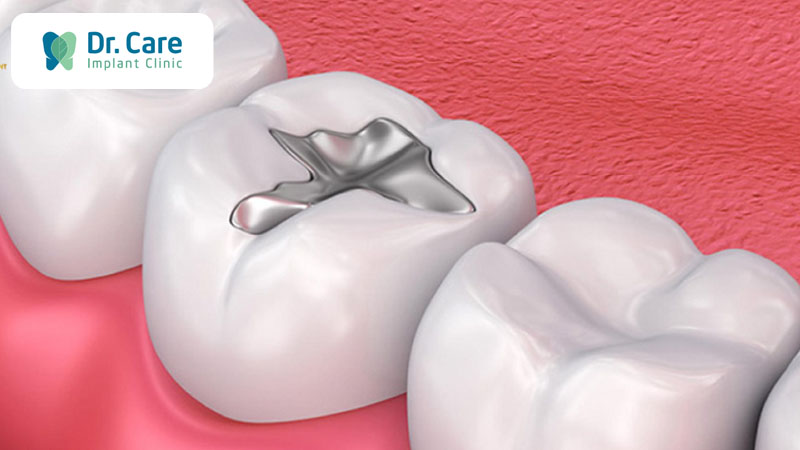 Điều trị răng bị nứt nhẹ bằng phương pháp trám răng