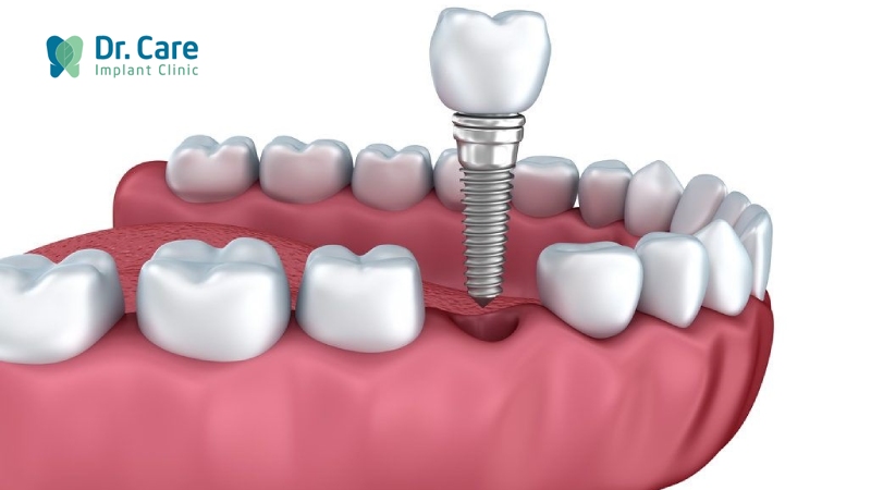 Trồng răng Implant, phục hồi răng bị mất do nứt men răng