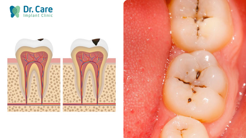 Đốm đen bề mặt chân răng là dấu hiệu của răng sâu