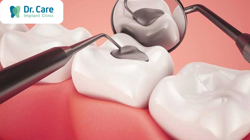 Trám răng là giải pháp chữa răng sâu phổ biến