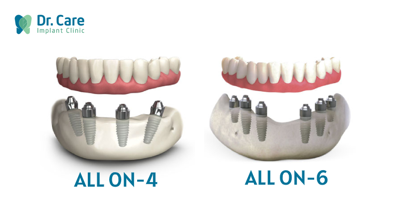 2 Phương pháp phục hồi răng toàn hàm trên Implant hiện nay