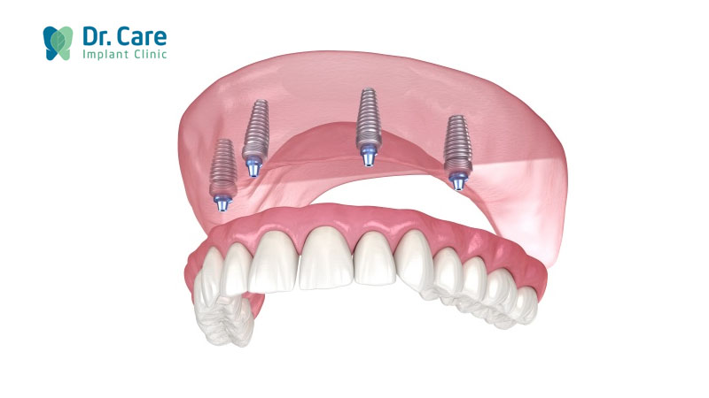 Phục hồi răng toàn hàm trên Implant là gì? 