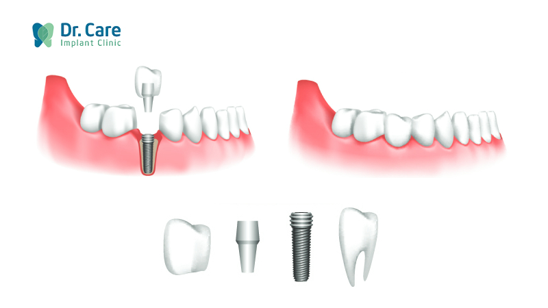 Trồng răng Implant đơn lẻ và nguyên hàm giá bao nhiêu?