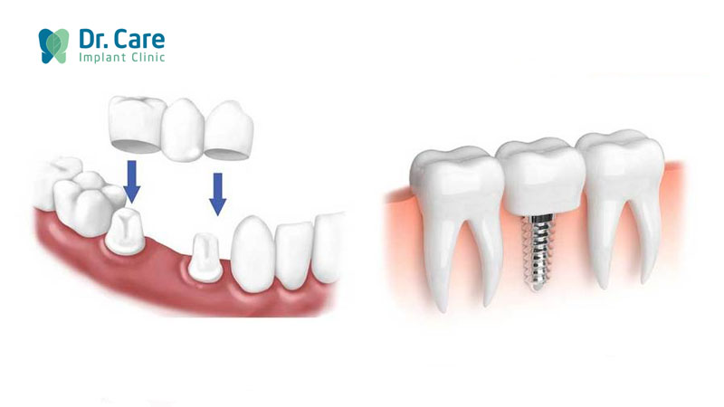 Trồng răng Implant khắc phục nhược điểm của cầu răng sứ