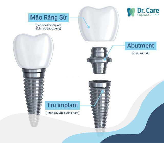 Trồng răng Implant - giải pháp phục hồi chức năng răng tối ưu nhất