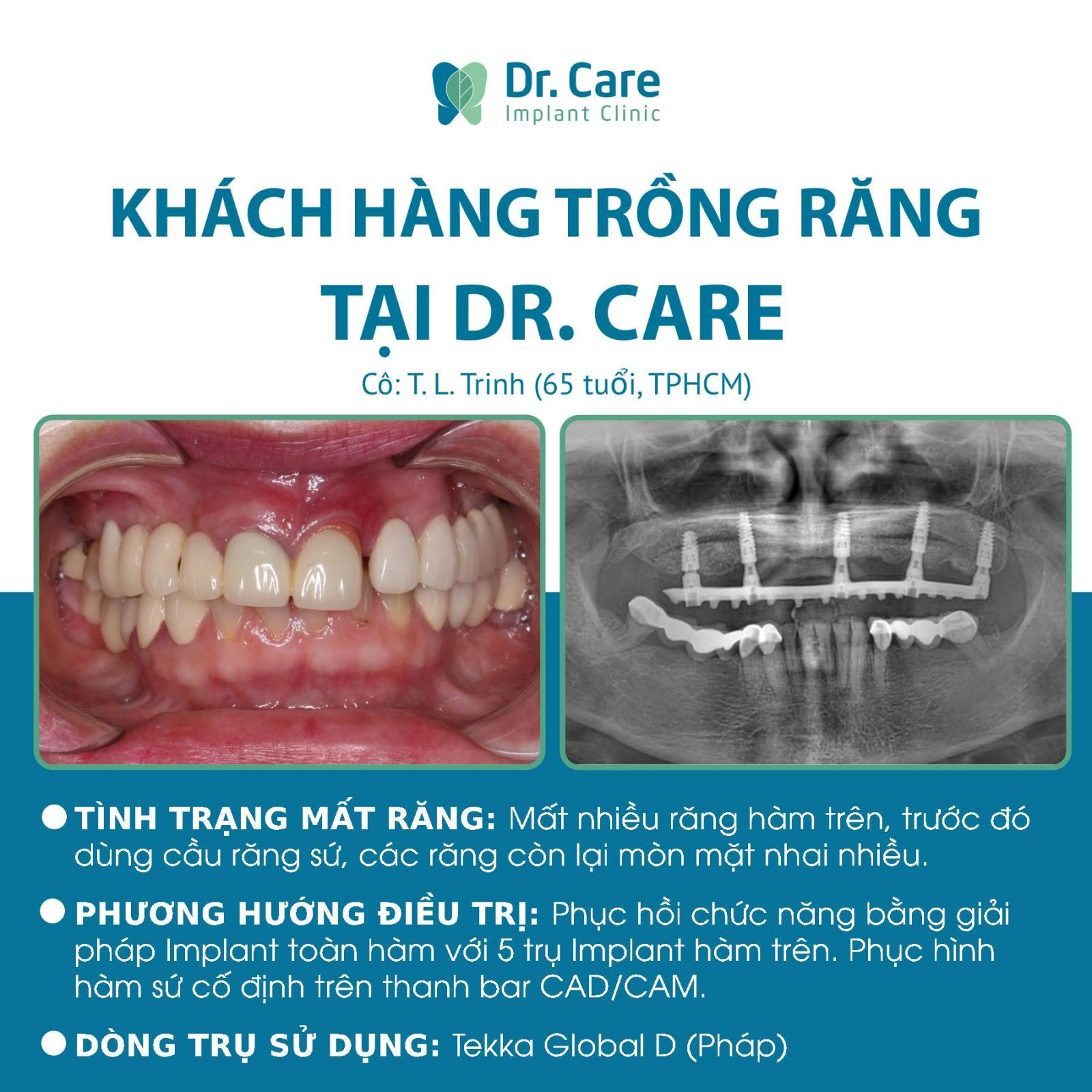 Khách hàng trồng răng nguyên hàm tại Dr.Care - Implant Clinic nói gì?