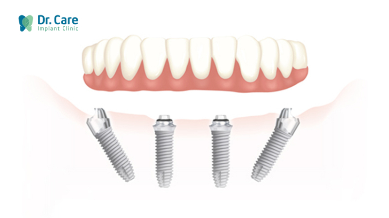 Hàm răng giả tháo lắp trên Implant