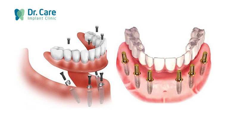 Chi phí trồng răng Implant hàm dưới mất bao nhiêu tiền