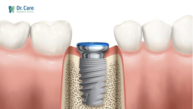 Trồng răng Implant đơn lẻ hàm dưới