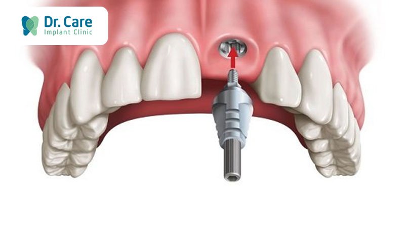 Trồng răng Implant đơn lẻ hàm trên