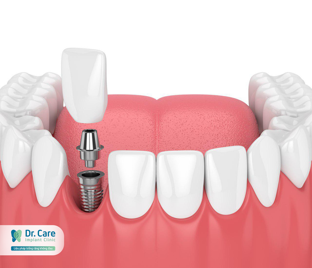 Trồng răng Implant trả góp là gì?