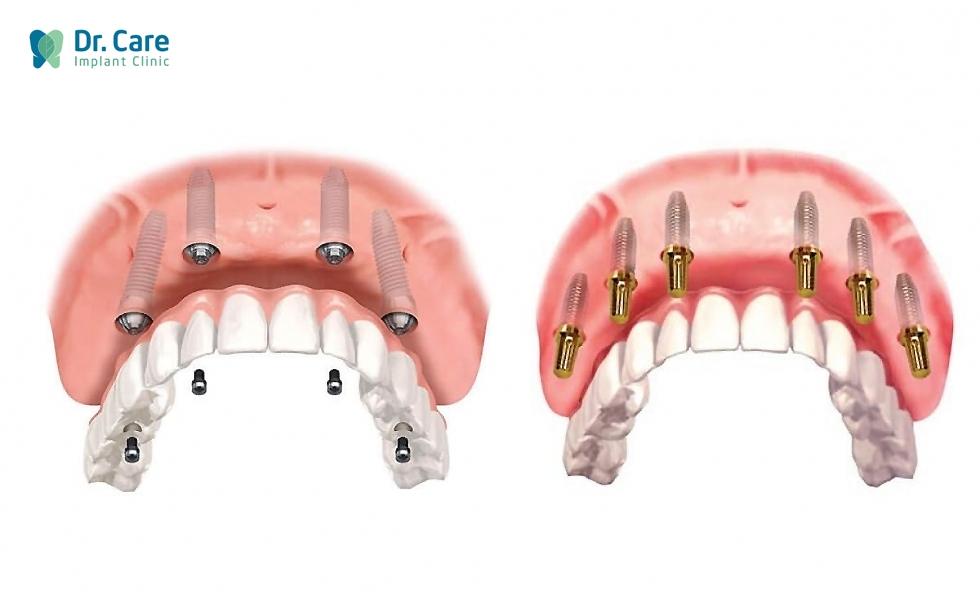 Trồng răng Implant toàn hàm loại nào tốt?