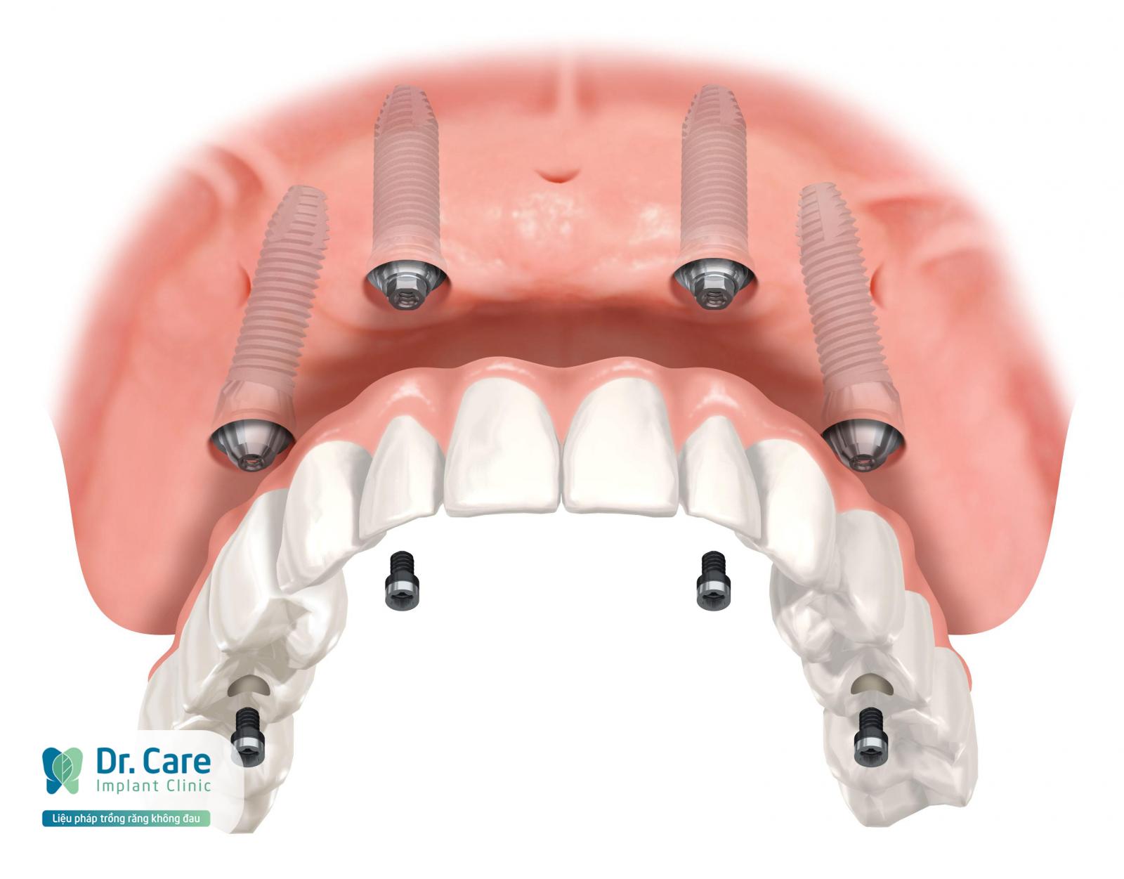 Trồng răng Implant toàn hàm là gì? Những ai nên trồng Implant nguyên hàm?