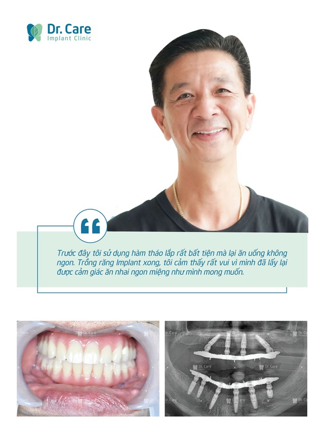 Trồng răng Implant toàn hàm loại nào tốt?