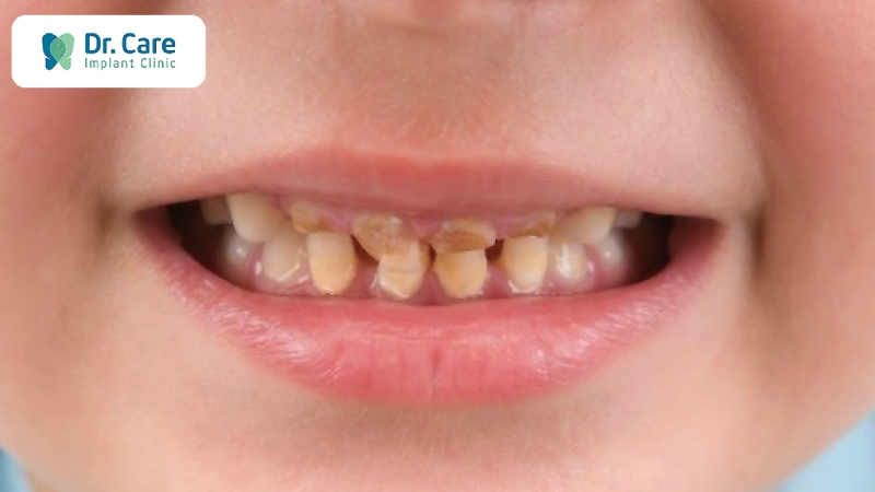 Xiết ăn răng có thể gặp ở nhiều đối tượng khác nhau