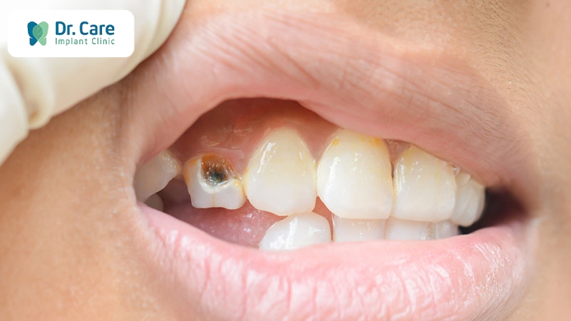 Xiết ăn răng là bệnh lý gì? Nguyên nhân do đâu?