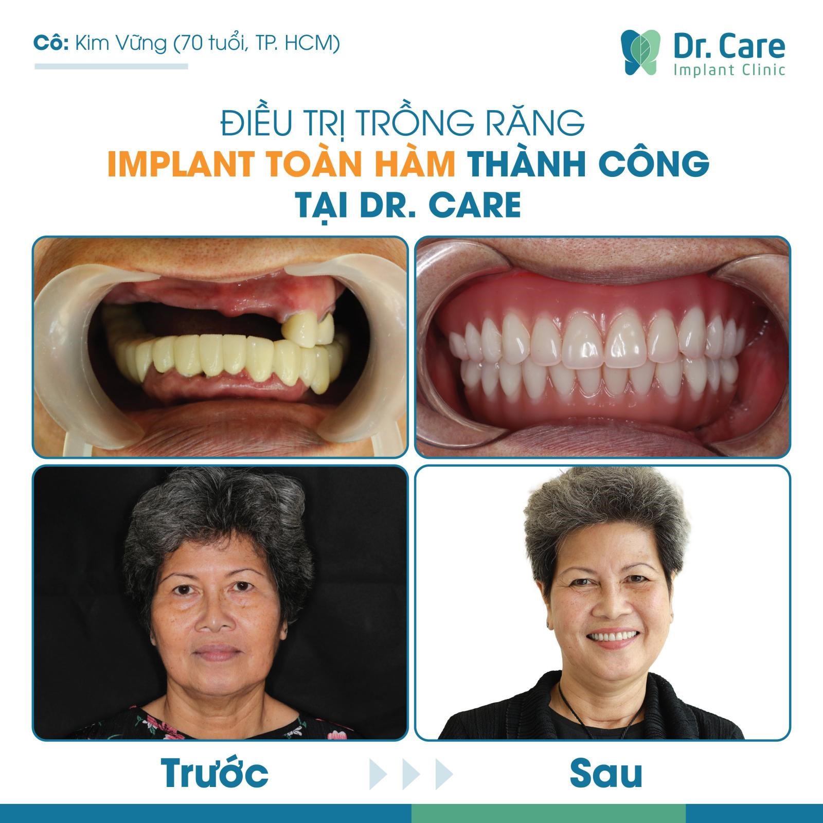 Cô Kim Vững mất 9 răng đã chọn phương pháp All on - 4 để điều trị