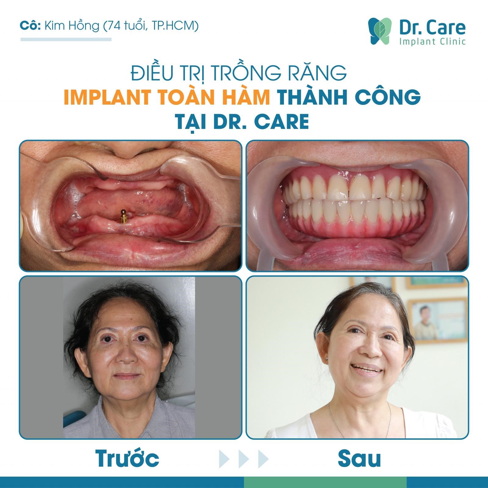 Cô Kim Hồng tại Tp, HCM trồng răng Implant All on - 4 thành công tại Dr. Care