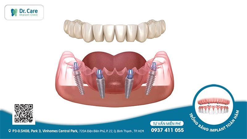 Trồng răng Implant All on - 4 