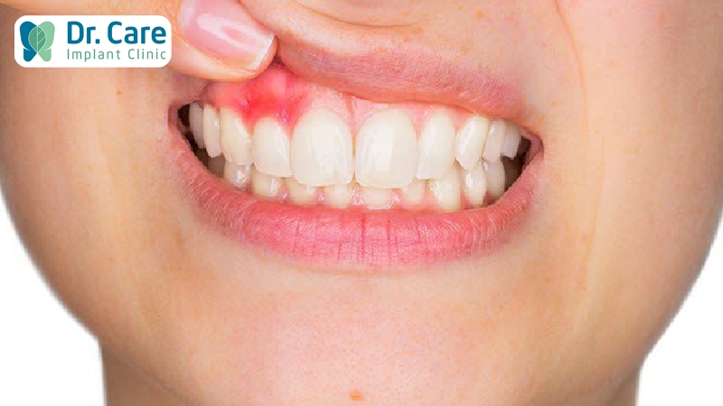 Răng mắc bệnh lý trước và sau khi bọc sứ