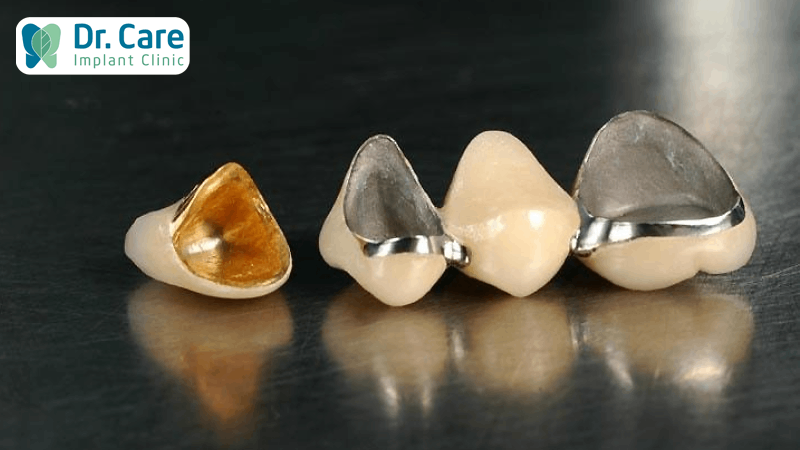 Răng sứ kim loại có tốt không?
