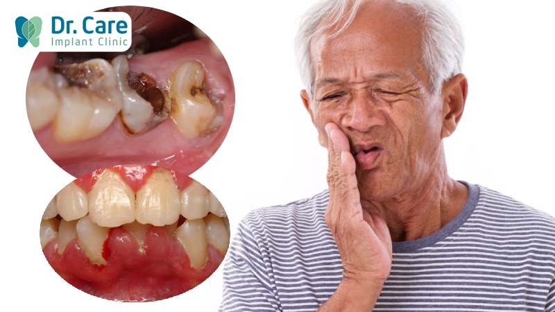 Nguyên nhân gây mất răng phổ biến