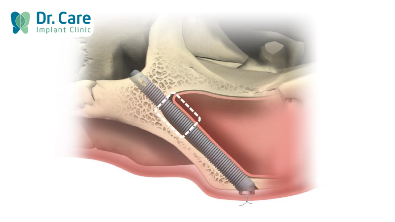 Cấy ghép Implant xương gò má là gì?