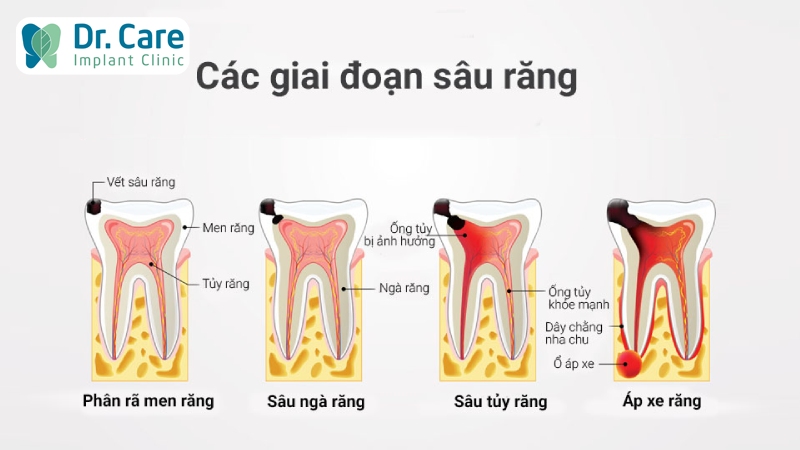 Những giai đoạn phát triển của sâu răng hàm 