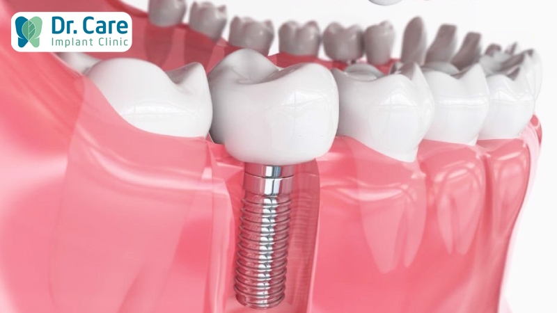 Trồng răng Implant thay thế răng hàm bị sâu phải nhổ bỏ